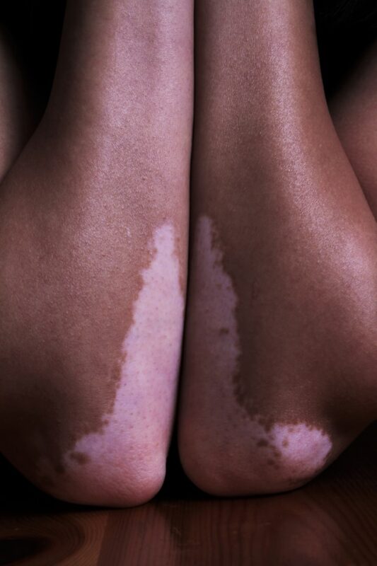 Treatments for Vitiligo