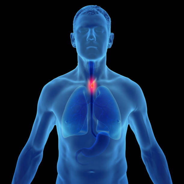 Symptoms of Esophagitis