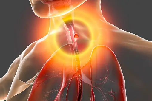 Symptoms of Esophageal Cancer