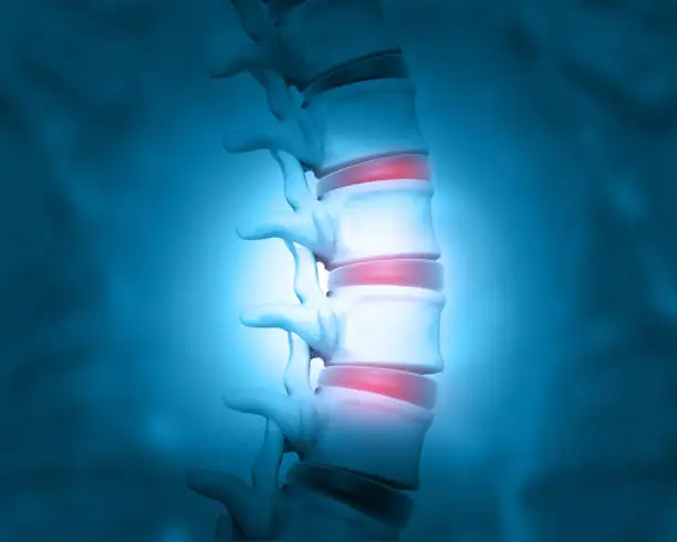 How Is Degenerative Disc Disease Diagnosed?