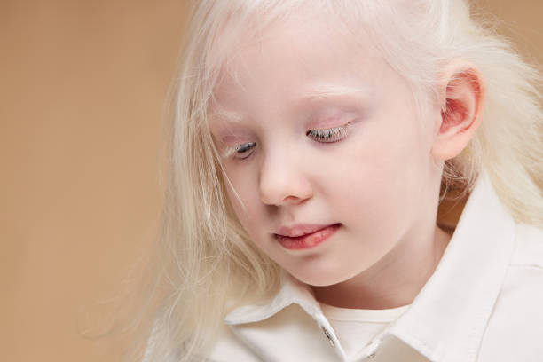 Symptoms of Albinism 