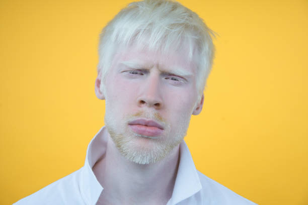 Causes of Albinism 