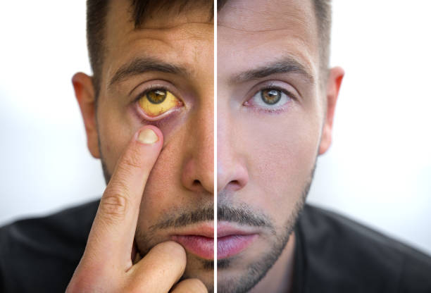 Types of Jaundice