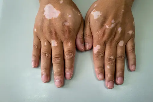 How Is Vitiligo Diagnosed?