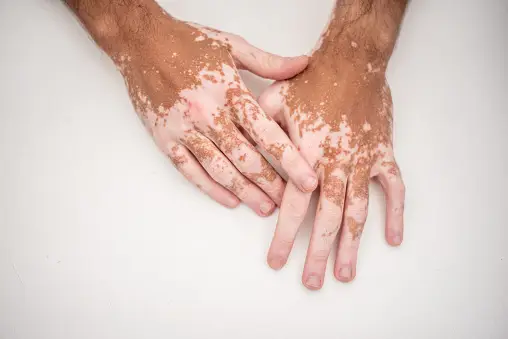 Types of Vitiligo