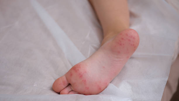 Complications of Hand, Foot, and Mouth Disease (HFMD)