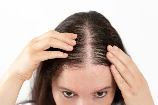 Symptoms of Alopecia