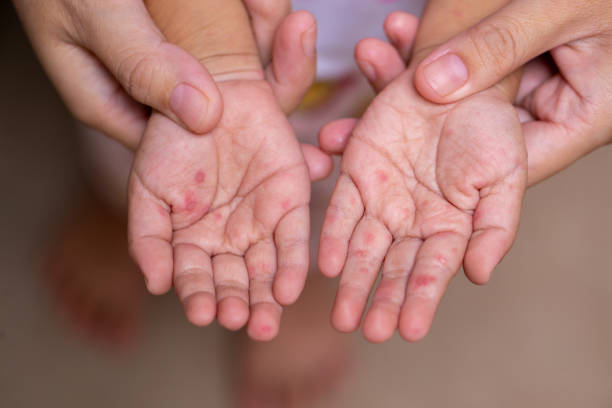 Diagnosis of Hand, Foot, and Mouth Disease (HFMD)