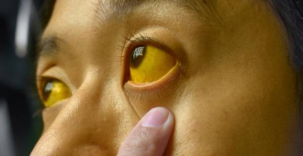 Causes of Jaundice