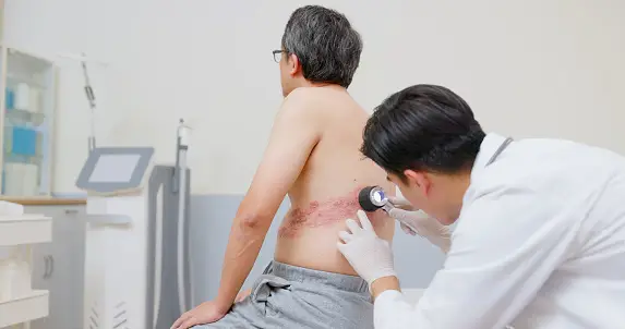 How Is Shingles Diagnosed?