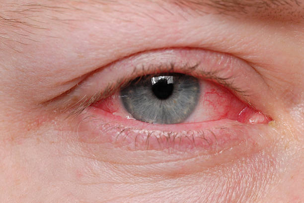 Irritant Conjunctivitis: