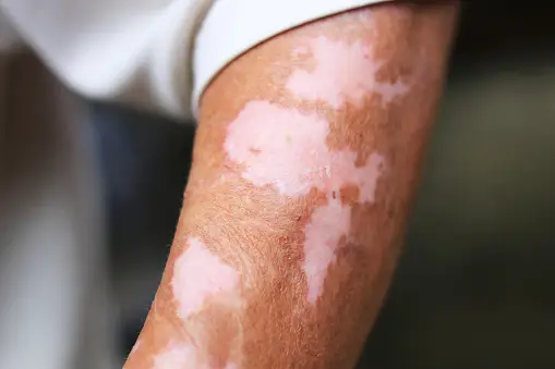 Causes of Vitiligo