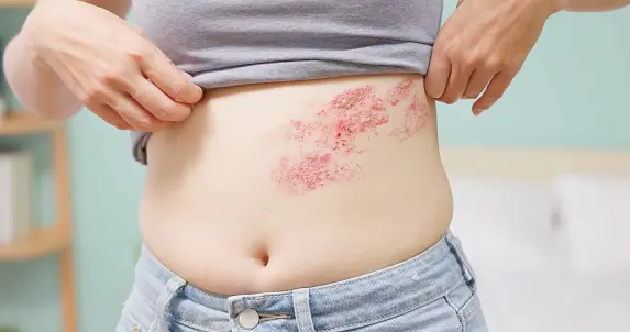 Symptoms of Shingles