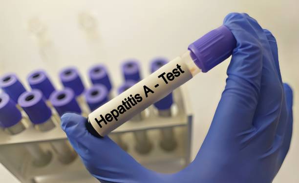 Diagnosis of Hepatitis A