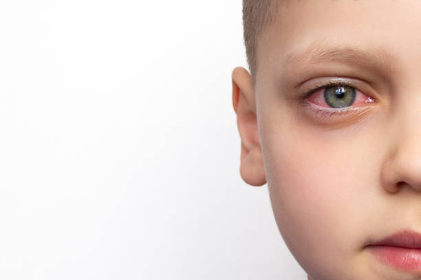 How Does Pink Eye Affect Children?