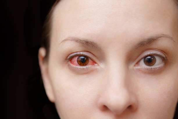 Bacterial Conjunctivitis: