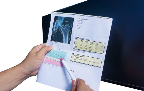 Diagnosis of Osteopenia