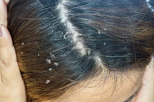 Types of Dandruff