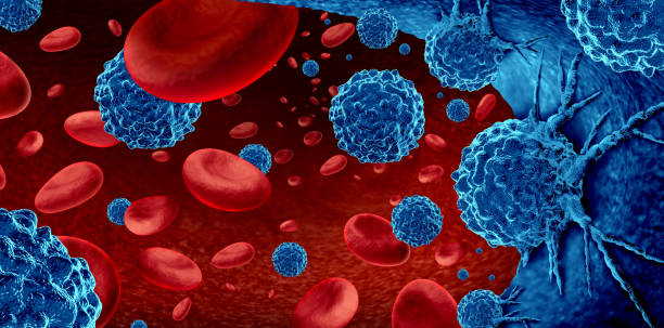 Types of Blood Cancer