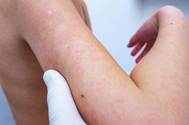 Causes of Hives (Urticaria)