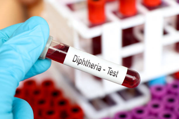 Diagnosis of Diphtheria