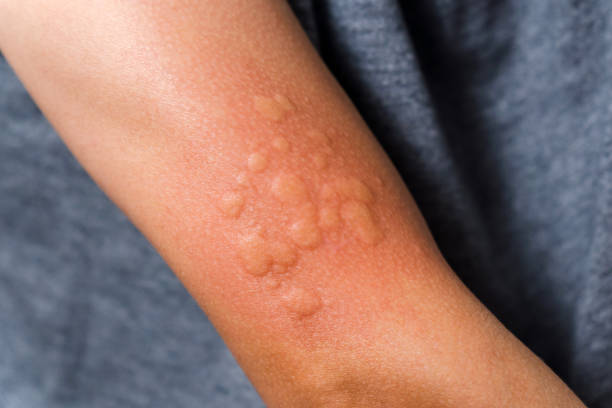 Symptoms of Hives (Urticaria)