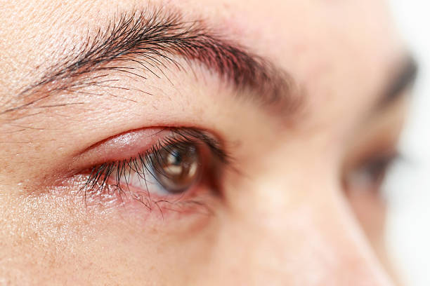 Symptoms of Blepharitis