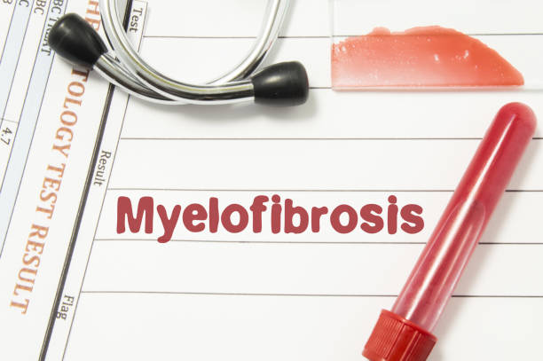 Diagnosis of Myelofibrosis