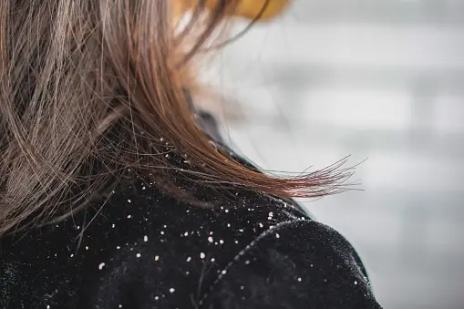 Diagnosis of Dandruff