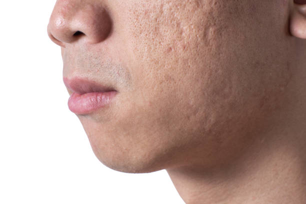 Complications of Acne Vulgaris