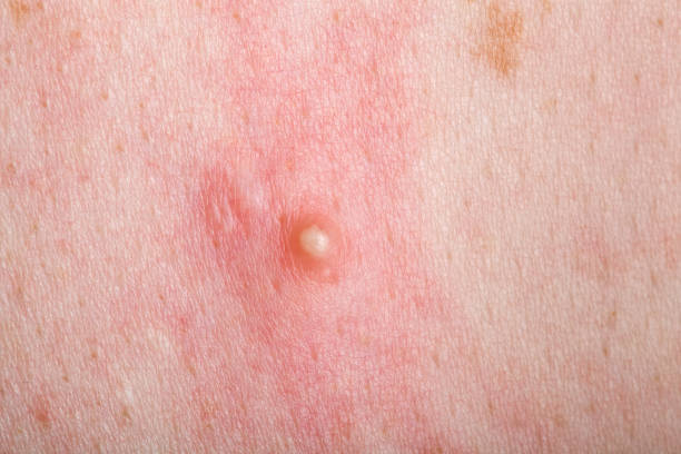 Symptoms of Inflammatory Acne