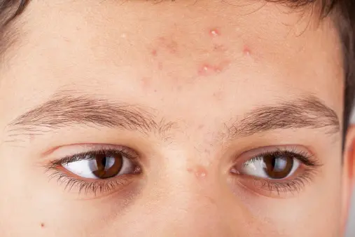 Types of Acne Vulgaris