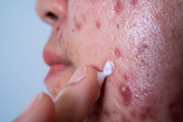 Treatment of Inflammatory Acne