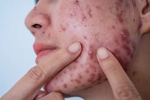 Causes of Acne Vulgaris