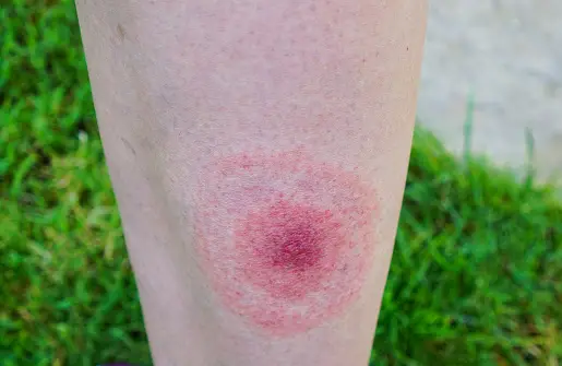 Symptoms of Lyme Disease